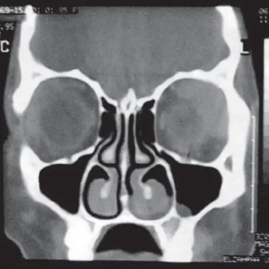Procedure of CT PNS (paranasal sinus)